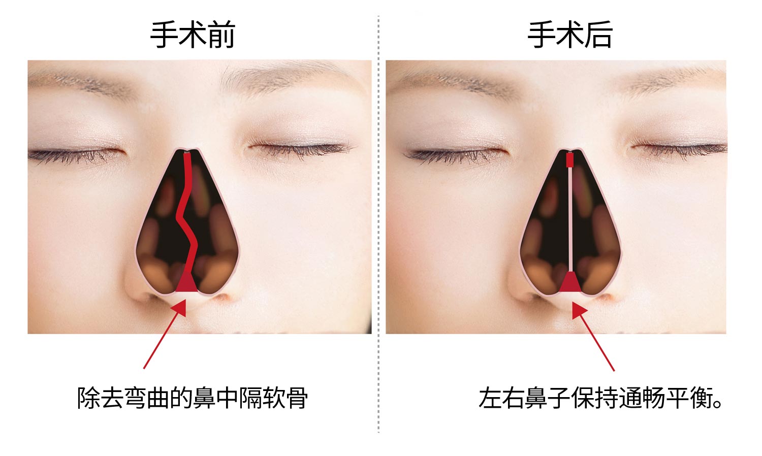 手术类型 适用 Sanka八幡西诊所 耳鼻喉科